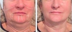High Intensity Focused Ultrasound, the Non-surgical Face lift!, Eyebrow Experts