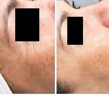 High Intensity Focused Ultrasound, the Non-surgical Face lift!, Eyebrow Experts